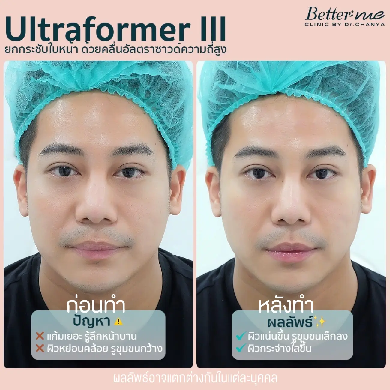 รีวิว Ultraformer III ที่ Better Me Clinic by Dr. Chanya รูป 3