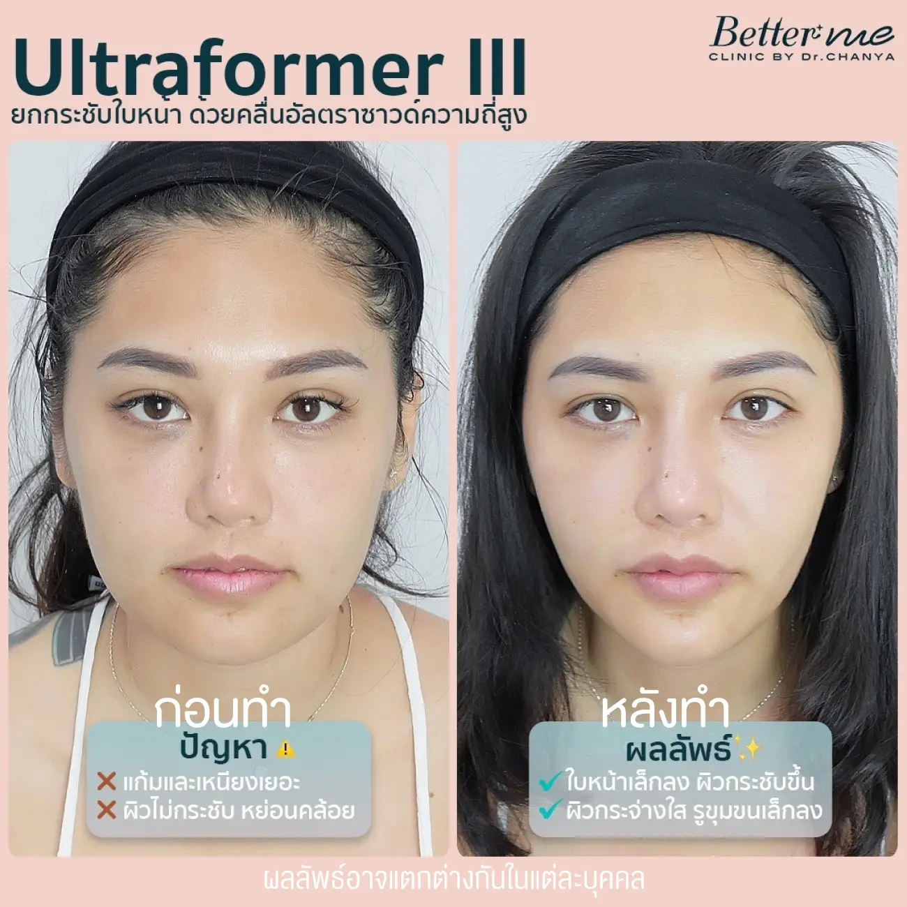 รีวิว Ultraformer III ที่ Better Me Clinic by Dr. Chanya รูป 4