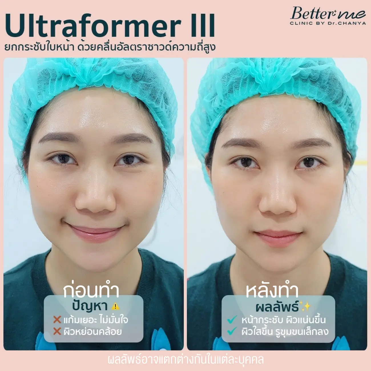 รีวิว Ultraformer III ที่ Better Me Clinic by Dr. Chanya รูป 5