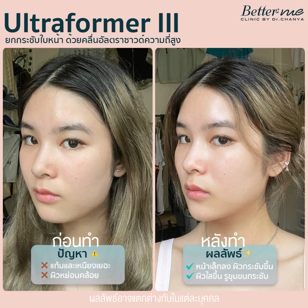 รีวิว Ultraformer III ที่ Better Me Clinic by Dr. Chanya รูป 1