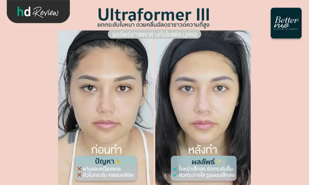 รีวิวยกกระชับหน้าด้วยโปรแกรม Ultraformer III ที่ Better Me Clinic by Dr. Chanya