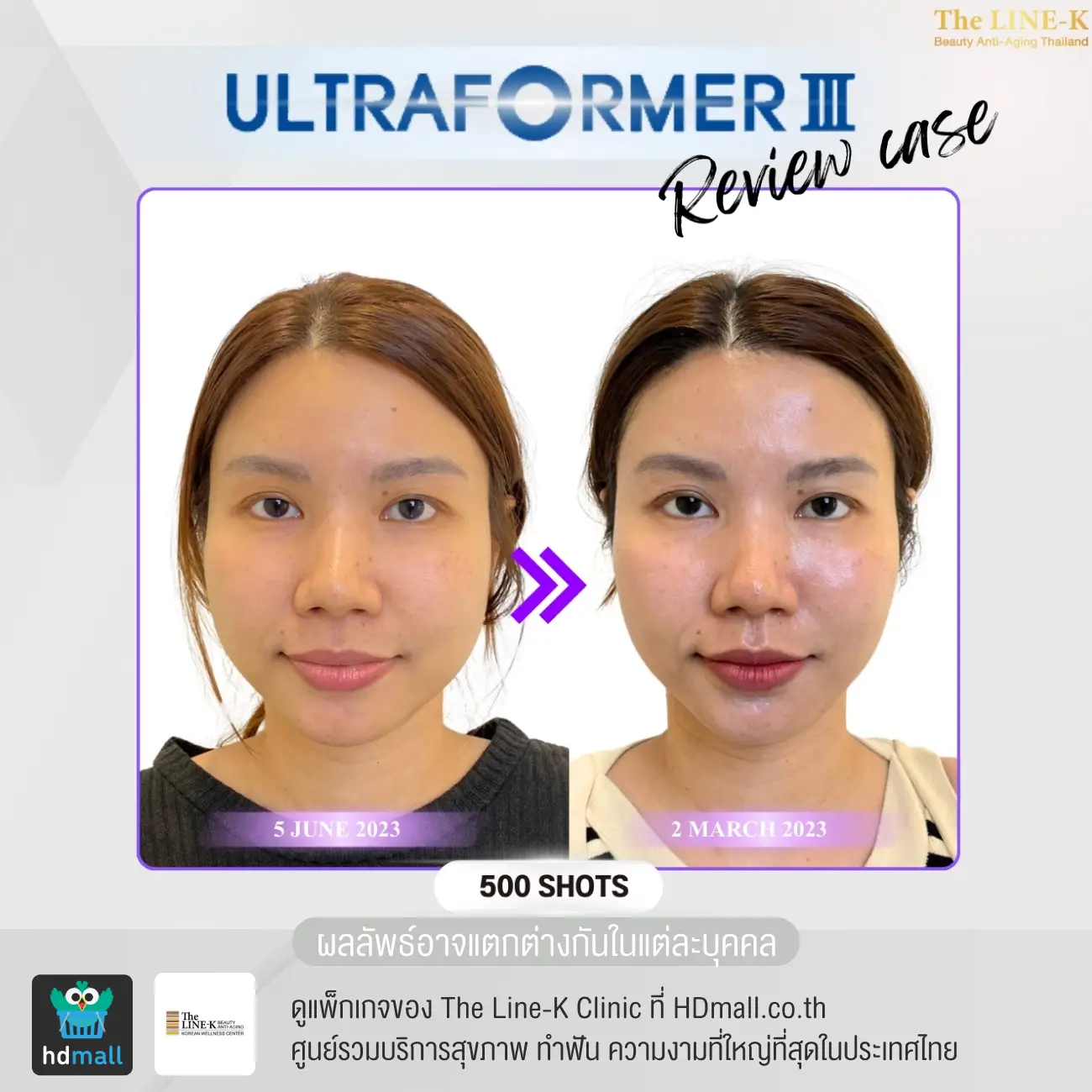 รีวิว Ultraformer III ที่ เดอะไลน์ เค คลินิกเวชกรรม รูปที่ 2