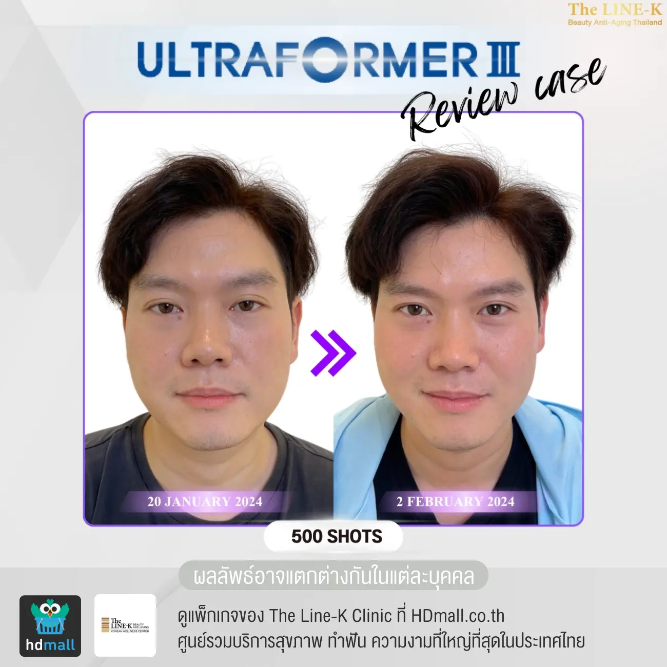 รีวิว Ultraformer III ที่ เดอะไลน์ เค คลินิกเวชกรรม รูปที่ 4