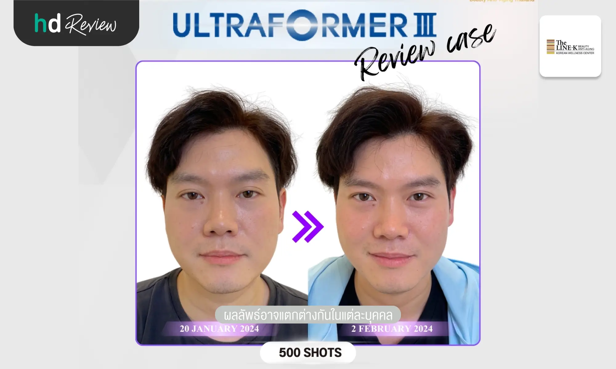 review before after ultraformeriii The Line K hero