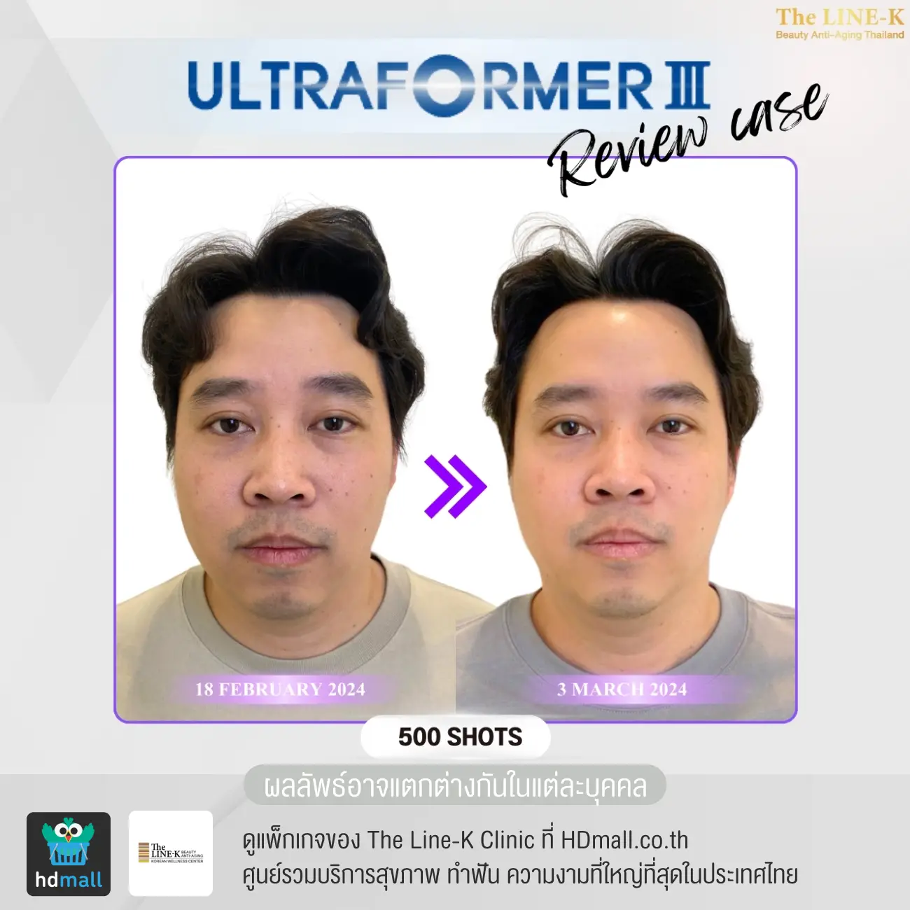 รีวิว Ultraformer III ที่ เดอะไลน์ เค คลินิกเวชกรรม รูปที่ 1