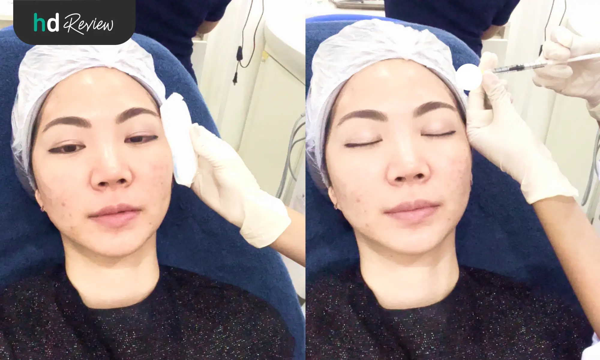 ขั้นตอนการฉีด Sculptra