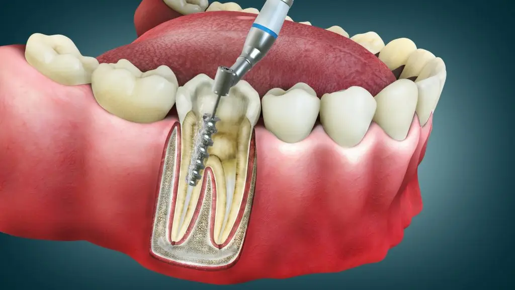 รักษารากฟัน (Root Canal) คือออะไร? ใครควรทำ?