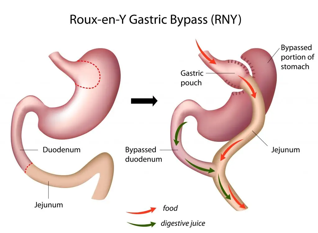 ผ่าตัดกระเพาะแบบบายพาส (Roux-en-Y หรือ Gastric Bypass)