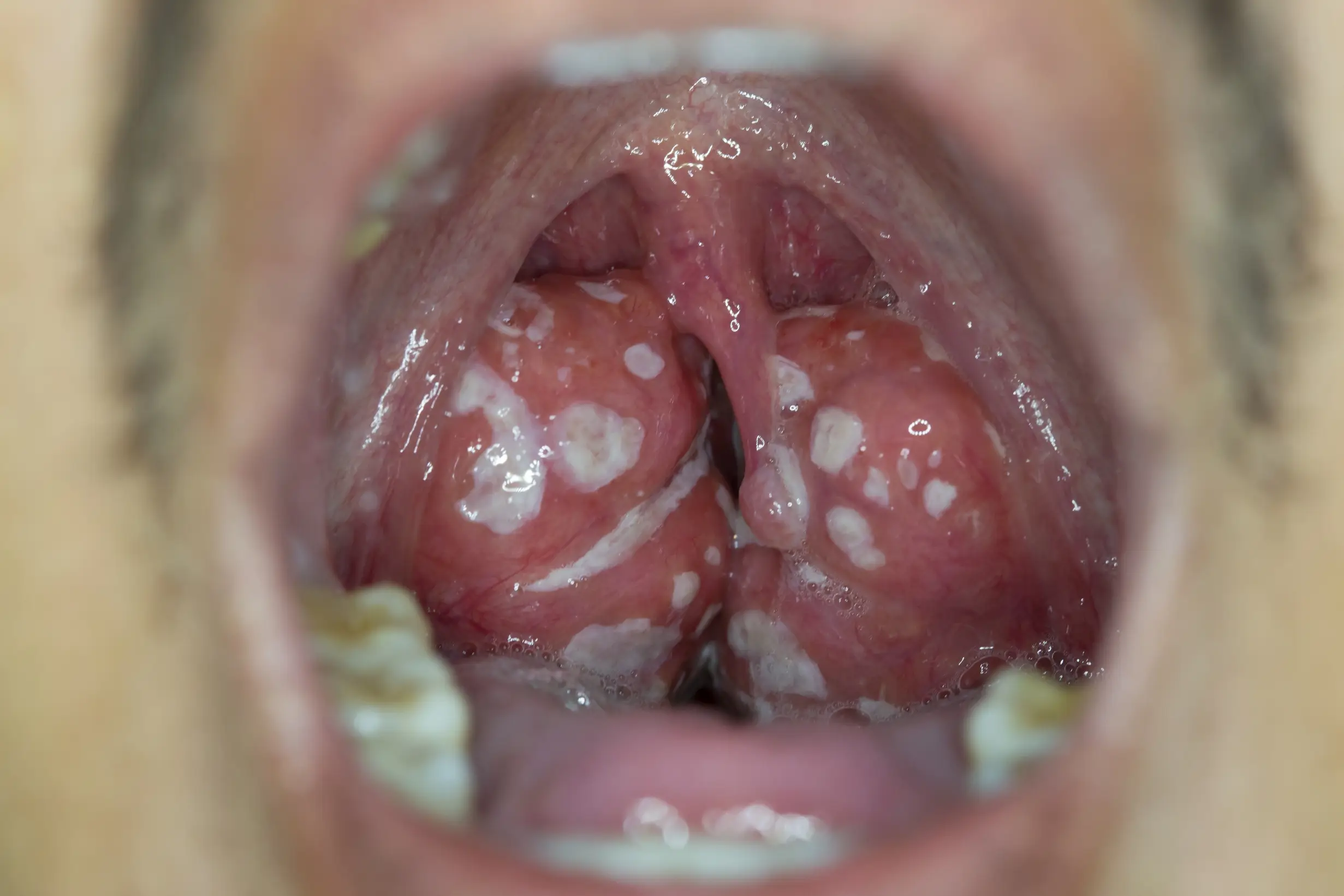 tonsil adenoid treatment process