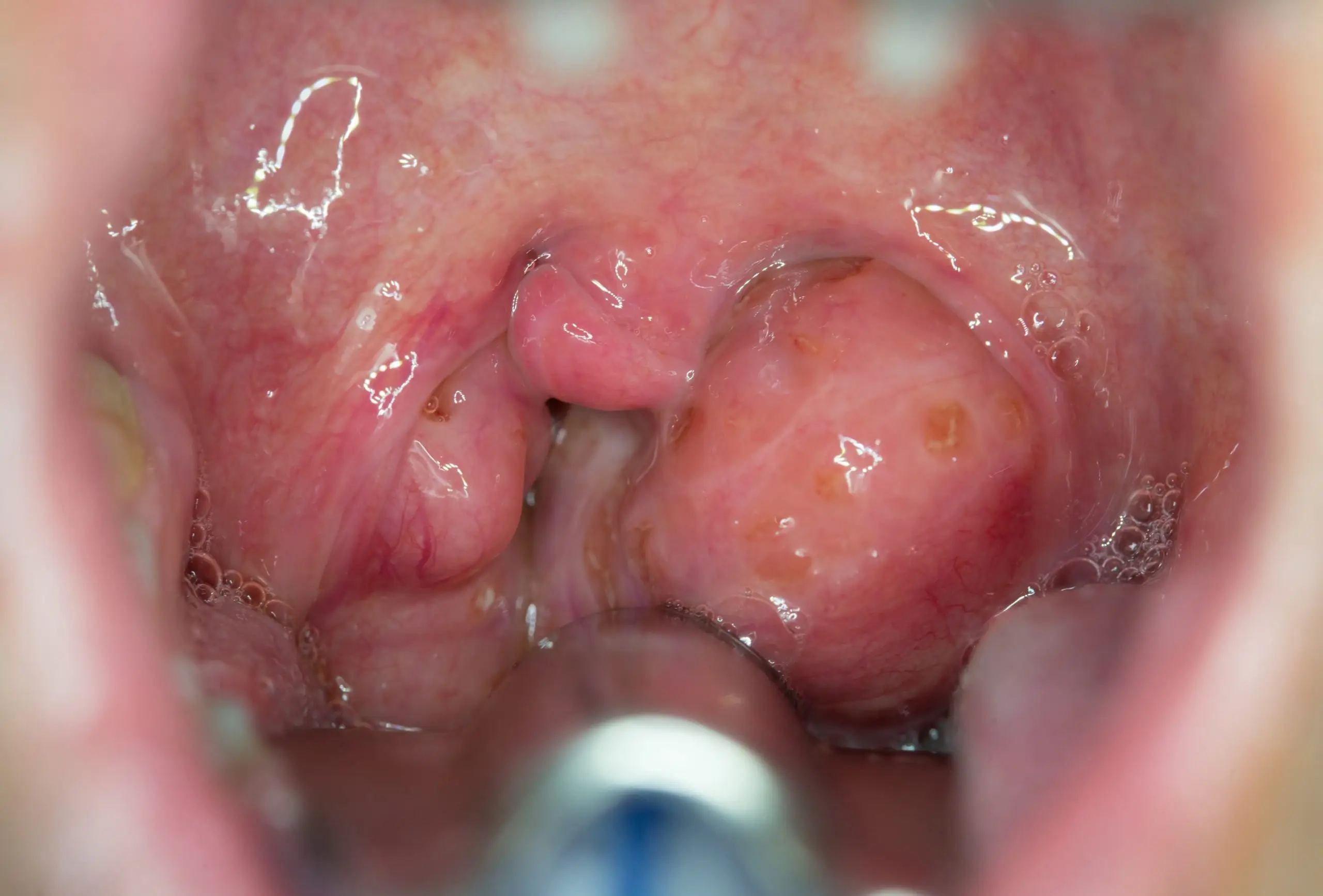 tonsil treatment process scaled