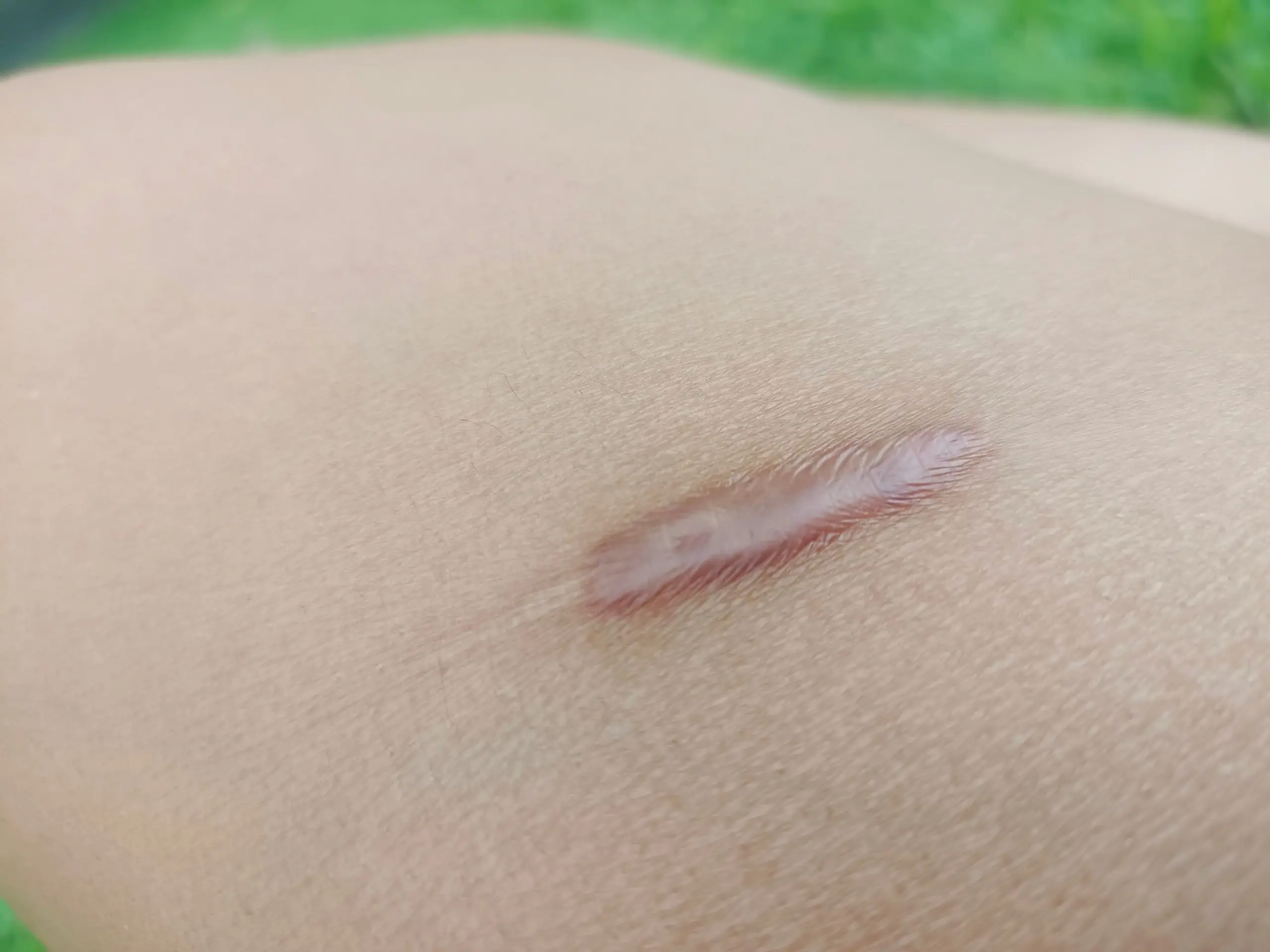 vitamin e help with scar removal scaled