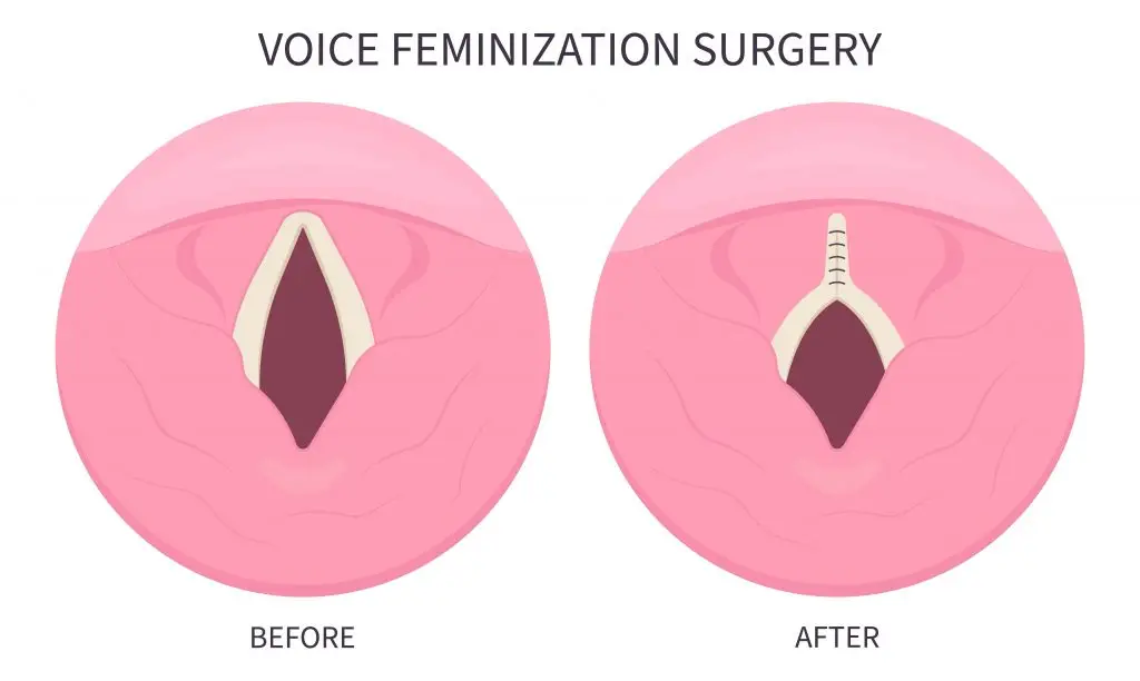 รวมเรื่องที่ต้องรู้เกี่ยวกับการผ่าตัดเปลี่ยนเสียงจากชายเป็นหญิง