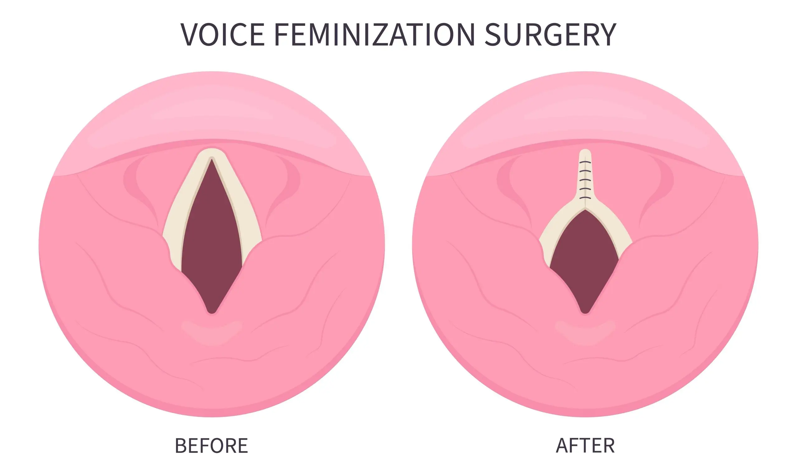 voice feminization surgery for transgender women scaled