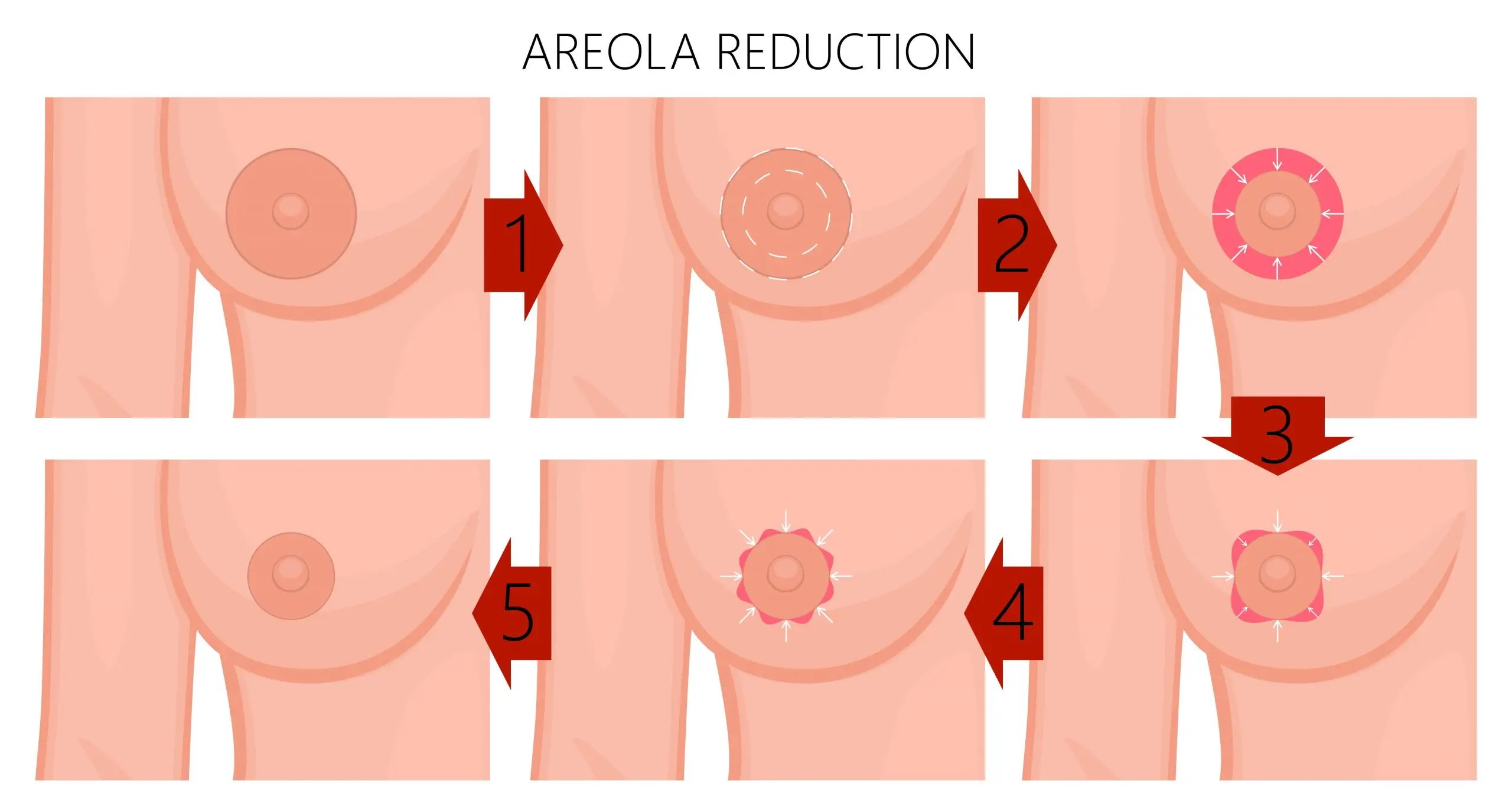 what is areola reduction 1 scaled