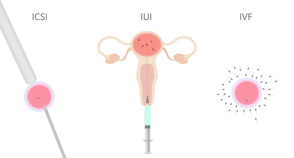 เจาะลึก IUI คืออะไร เหมาะกับใครบ้าง?