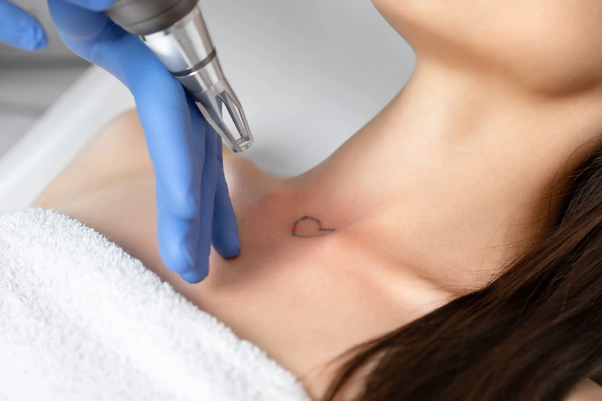 what is laser tattoo removal 1