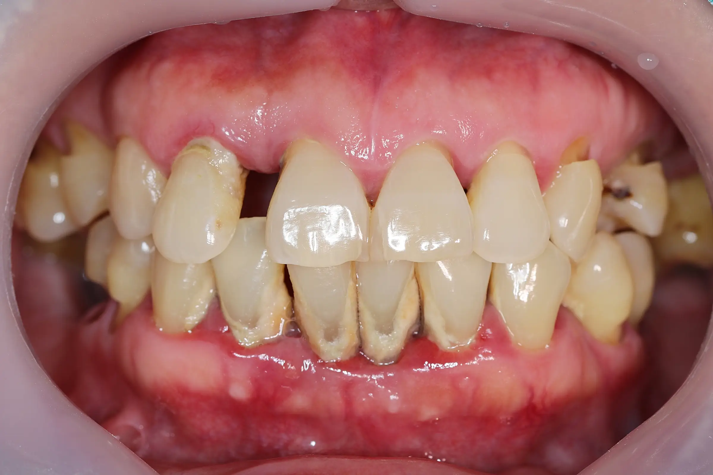 what is periodontitis 1