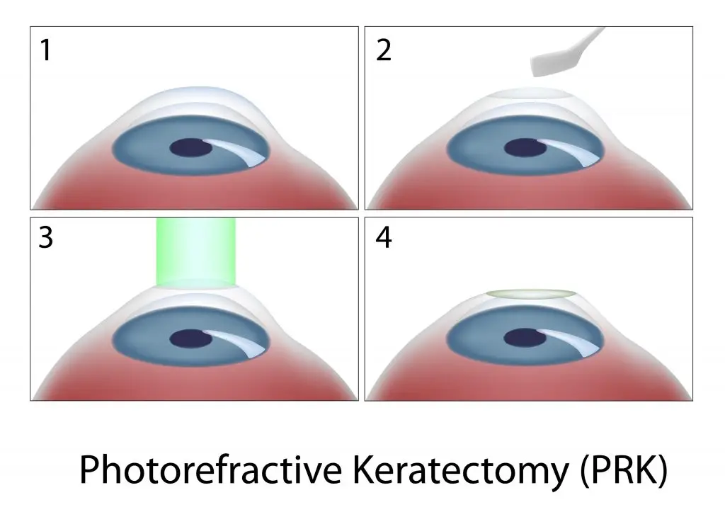 PRK อีกหนึ่งทางเลือกของคนทำเลสิกไม่ได้