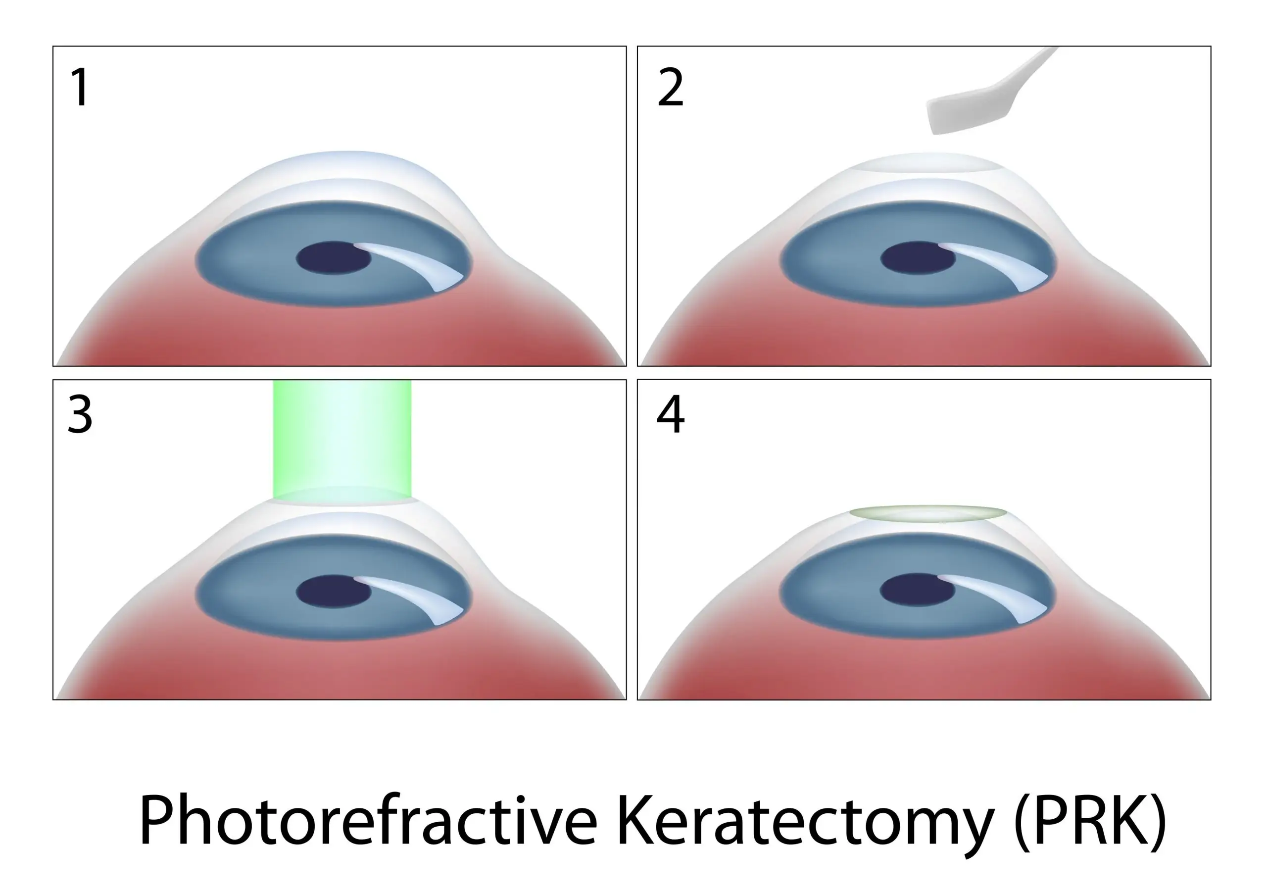 what is photorefractive keratectomy or prk scaled