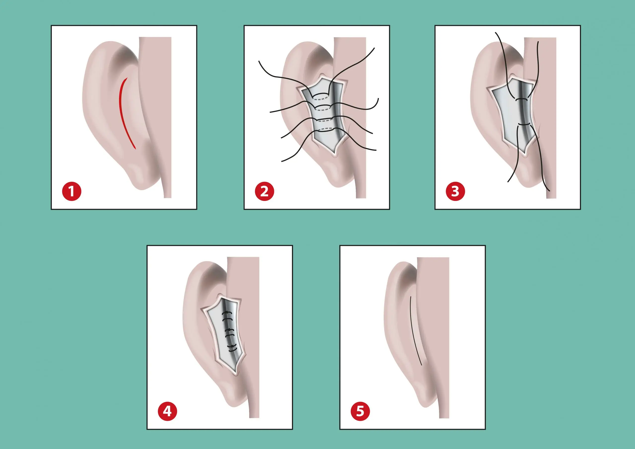 what to know about otoplasty treatment faq scaled