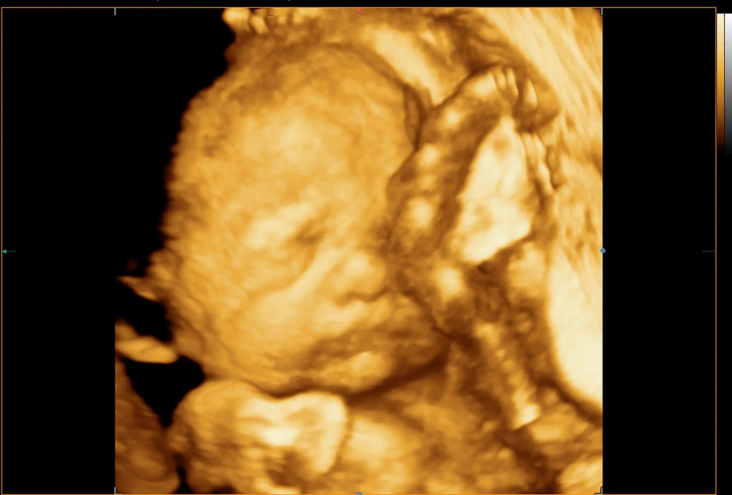 2d 3d 4d pregnancy ultrasound disease definition 02 scaled