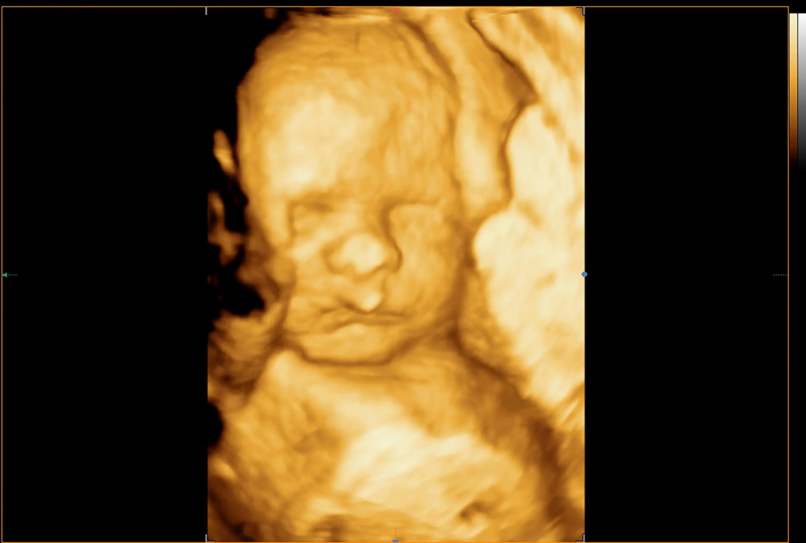 2d 3d 4d pregnancy ultrasound disease definition scaled