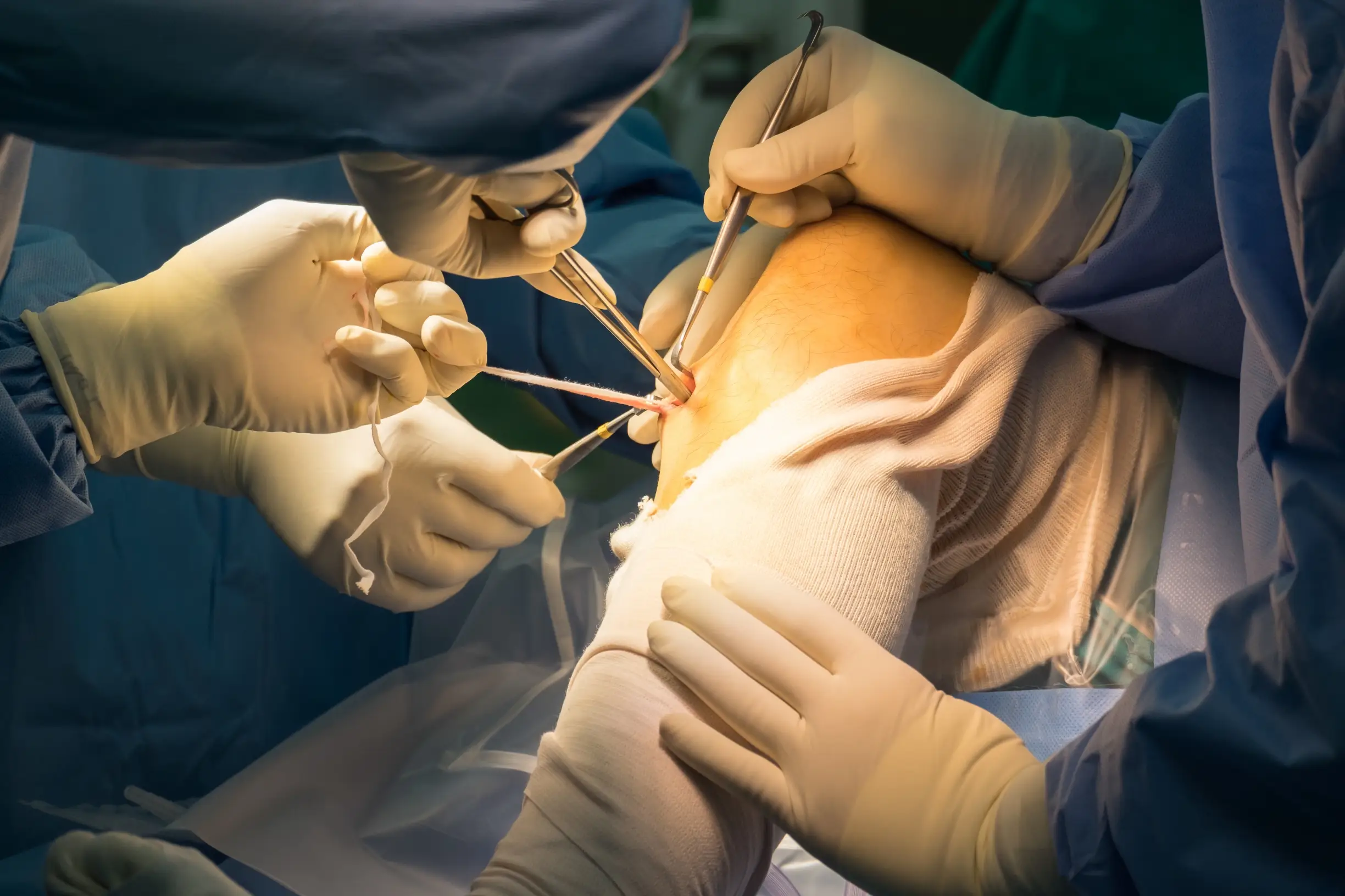 acl surgery treatment process