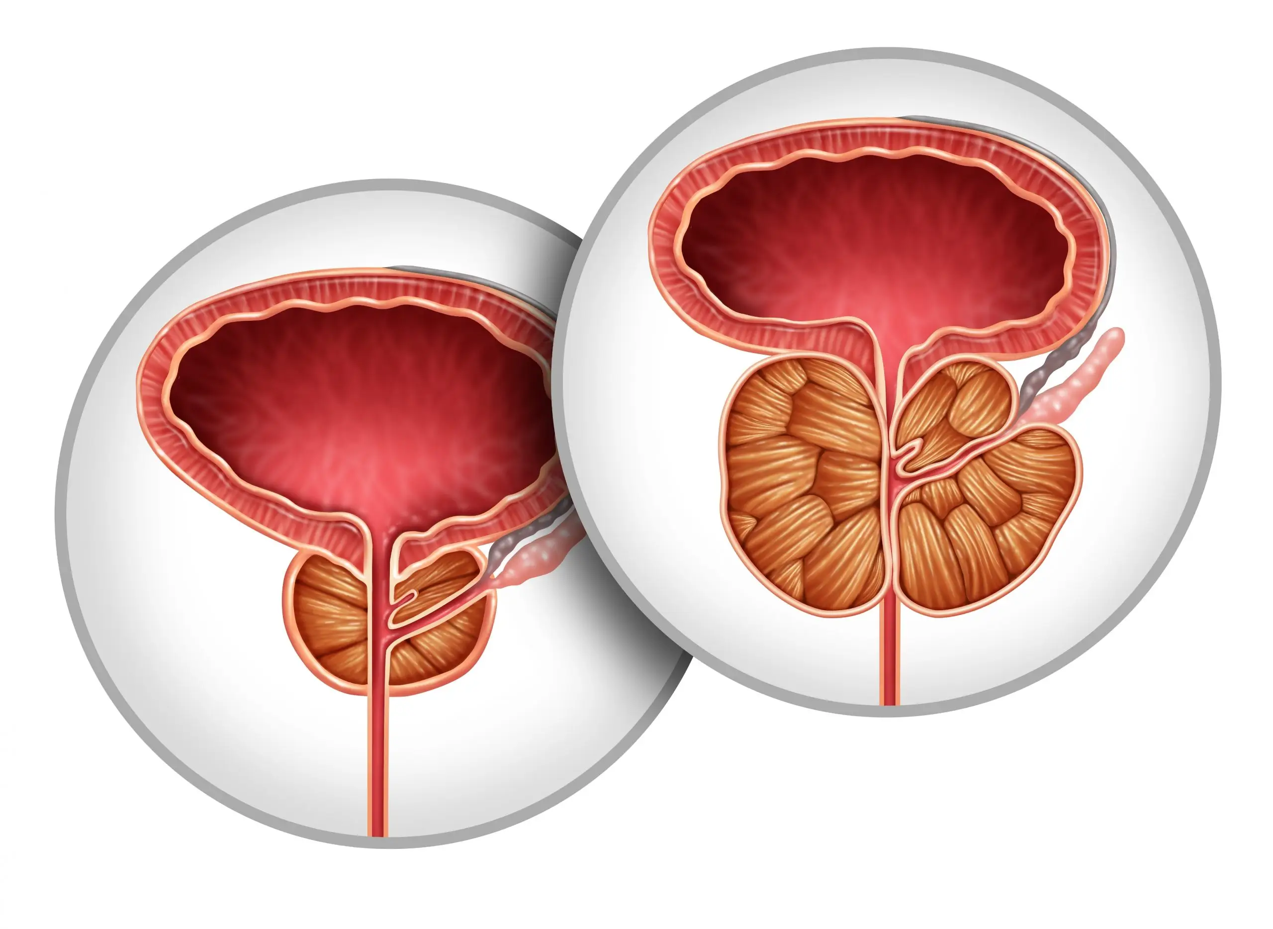 prostate cancer vs bhp facts disease definition scaled