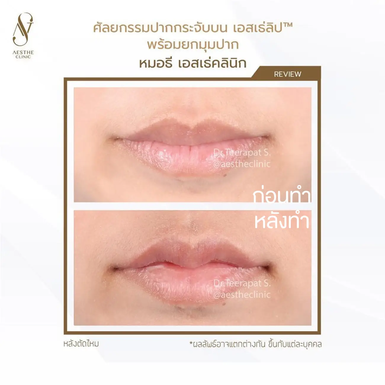 รีวิวศัลยกรรมปากกระจับ ที่ Aesthe Clinic (เอสเธ่คลินิก) รูปที่ 1