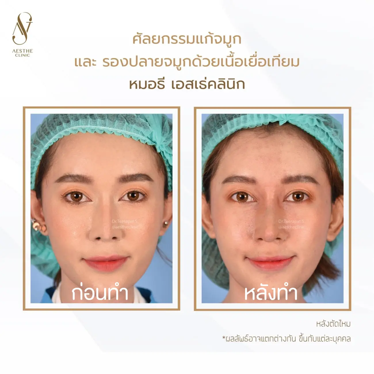 รีวิวแก้จมูกและรองปลายด้วยเนื้อเยื่อเทียม ที่ Aesthe Clinic (เอสเธ่คลินิก) รูปที่ 1