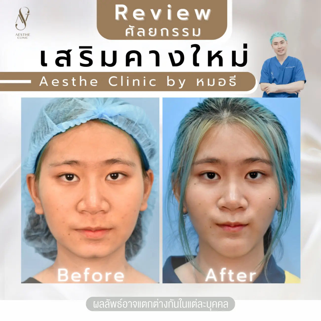 รีวิวทำคาง ที่ Aesthe Clinic (เอสเธ่คลินิก) รูปที่ 1