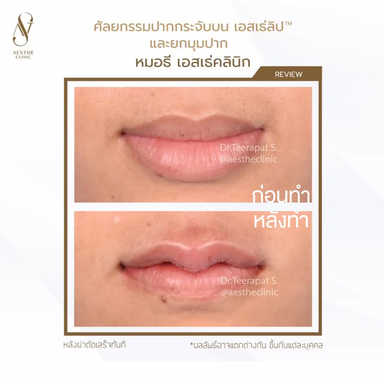 รีวิวศัลยกรรมปากกระจับ ที่ Aesthe Clinic (เอสเธ่คลินิก) รูปที่ 2