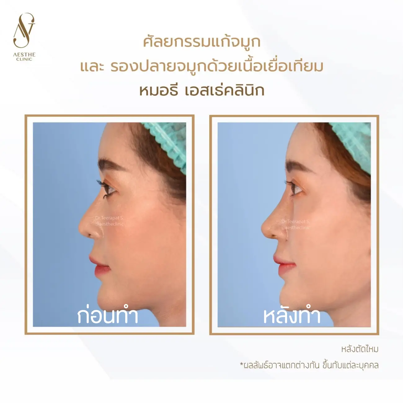 รีวิวแก้จมูกและรองปลายด้วยเนื้อเยื่อเทียม ที่ Aesthe Clinic (เอสเธ่คลินิก) รูปที่ 2