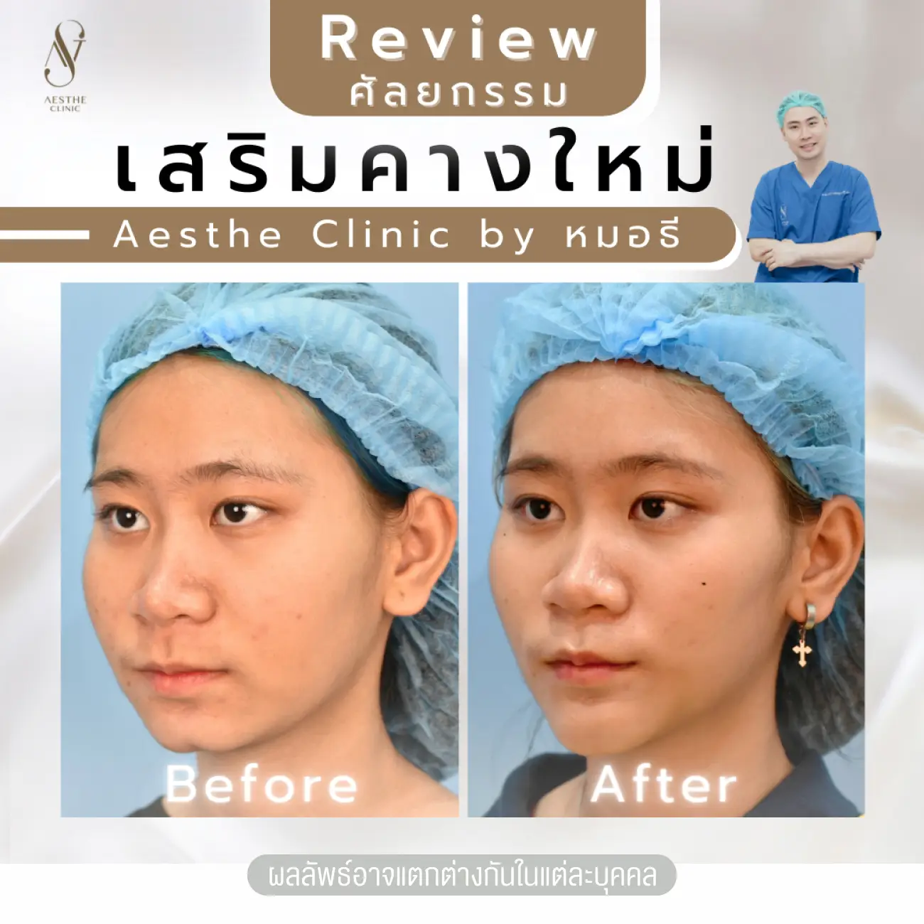 รีวิวทำคาง ที่ Aesthe Clinic (เอสเธ่คลินิก) รูปที่ 2