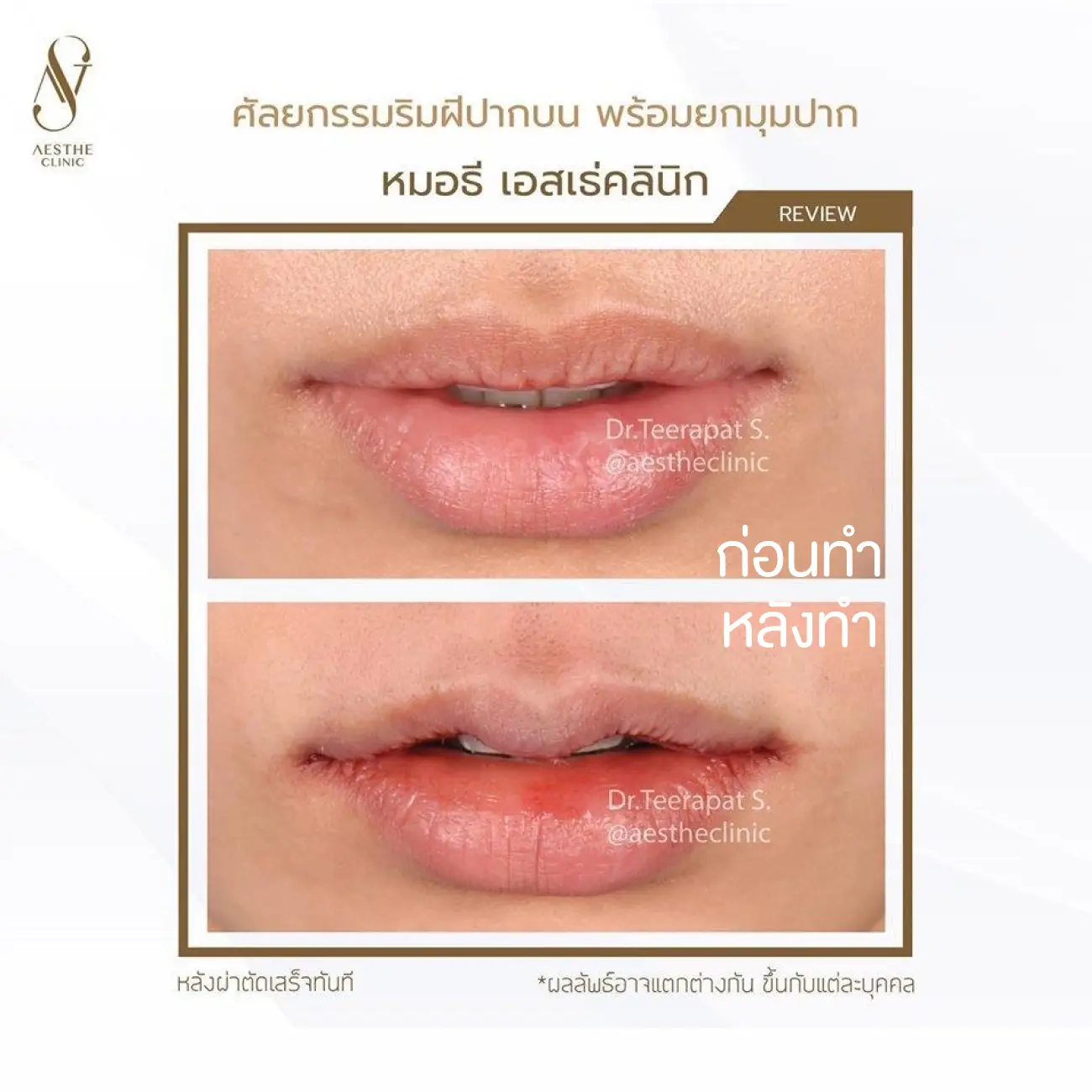 รีวิวศัลยกรรมปากกระจับ ที่ Aesthe Clinic (เอสเธ่คลินิก) รูปที่ 3