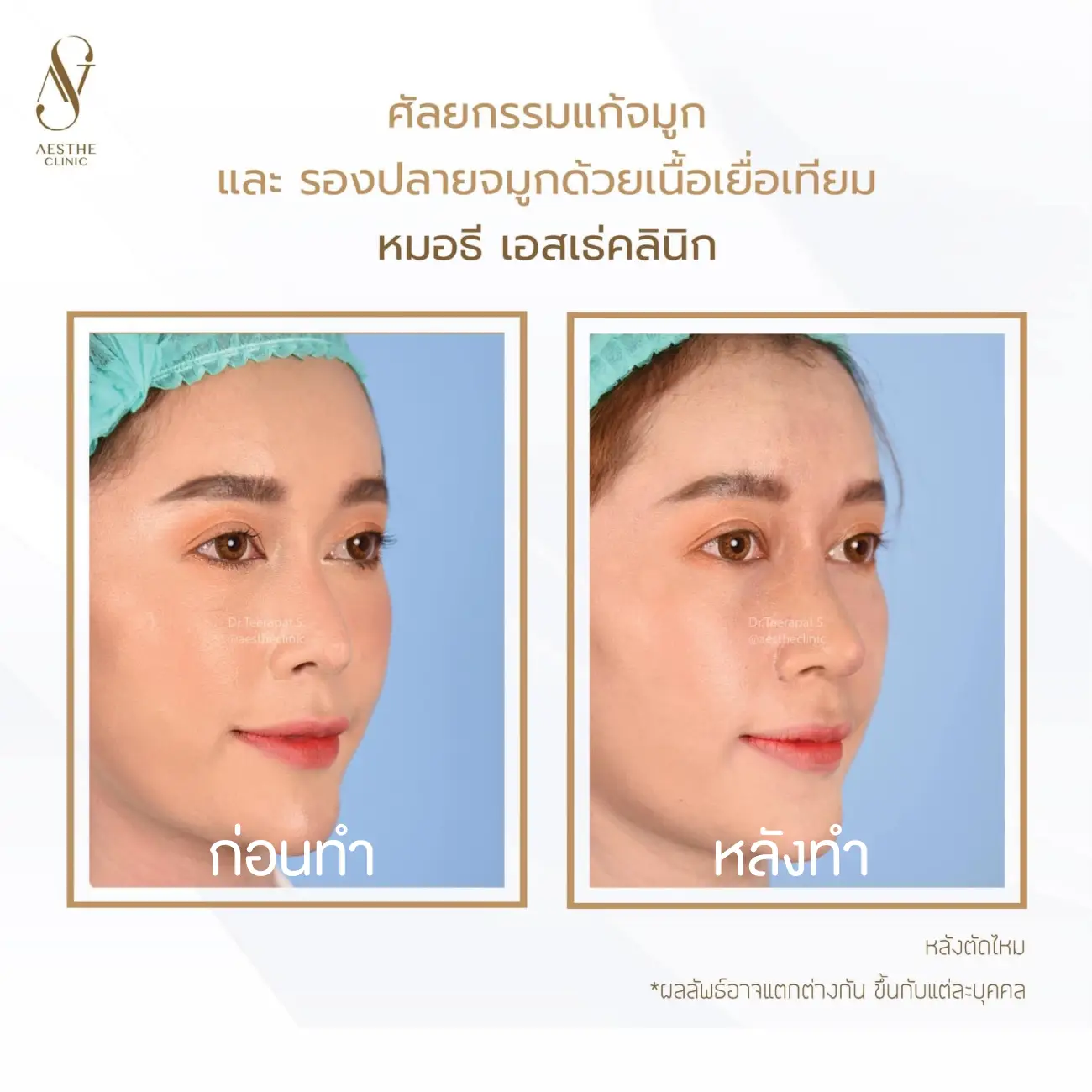 รีวิวแก้จมูกและรองปลายด้วยเนื้อเยื่อเทียม ที่ Aesthe Clinic (เอสเธ่คลินิก) รูปที่ 3