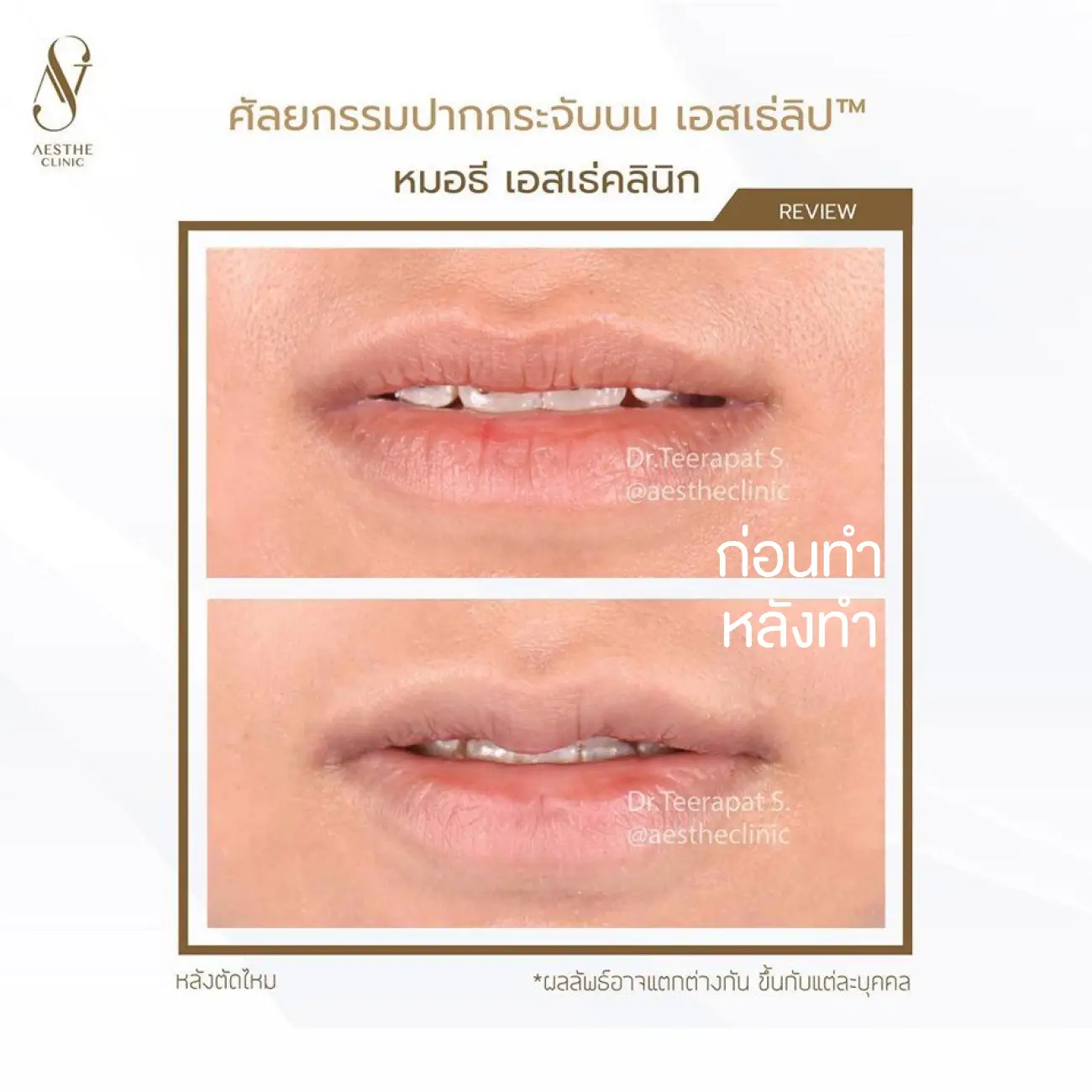 รีวิวศัลยกรรมปากกระจับ ที่ Aesthe Clinic (เอสเธ่คลินิก) รูปที่ 4