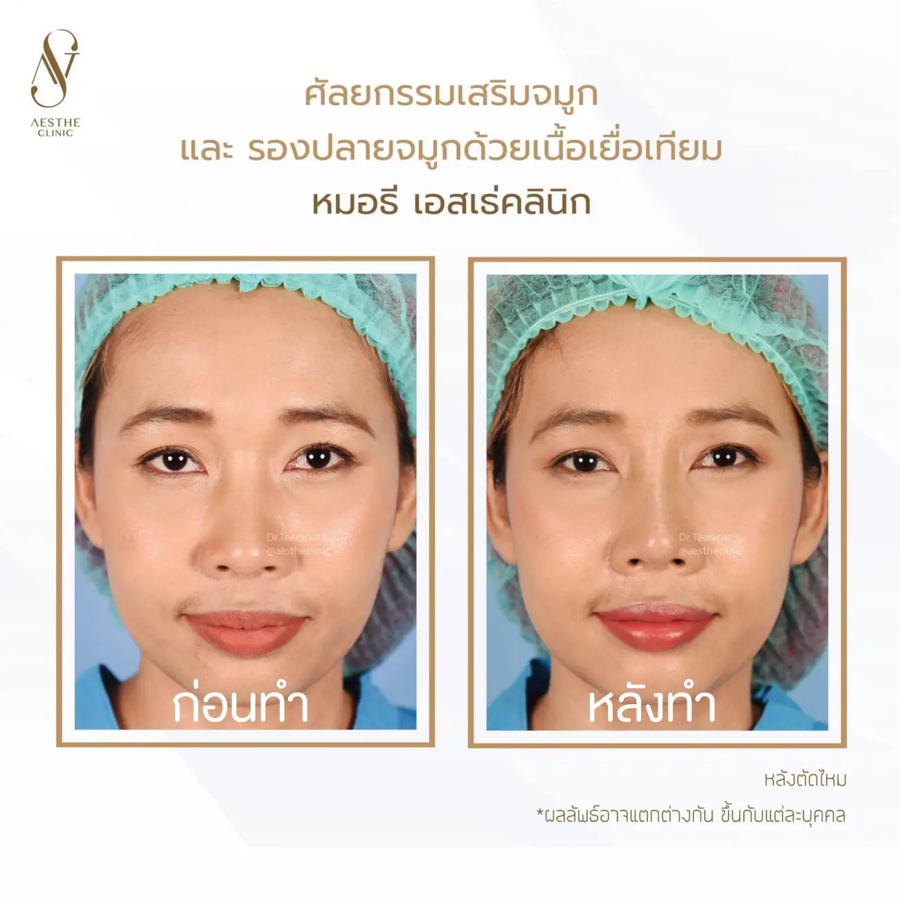 รีวิวแก้จมูกและรองปลายด้วยเนื้อเยื่อเทียม ที่ Aesthe Clinic (เอสเธ่คลินิก) รูปที่ 4