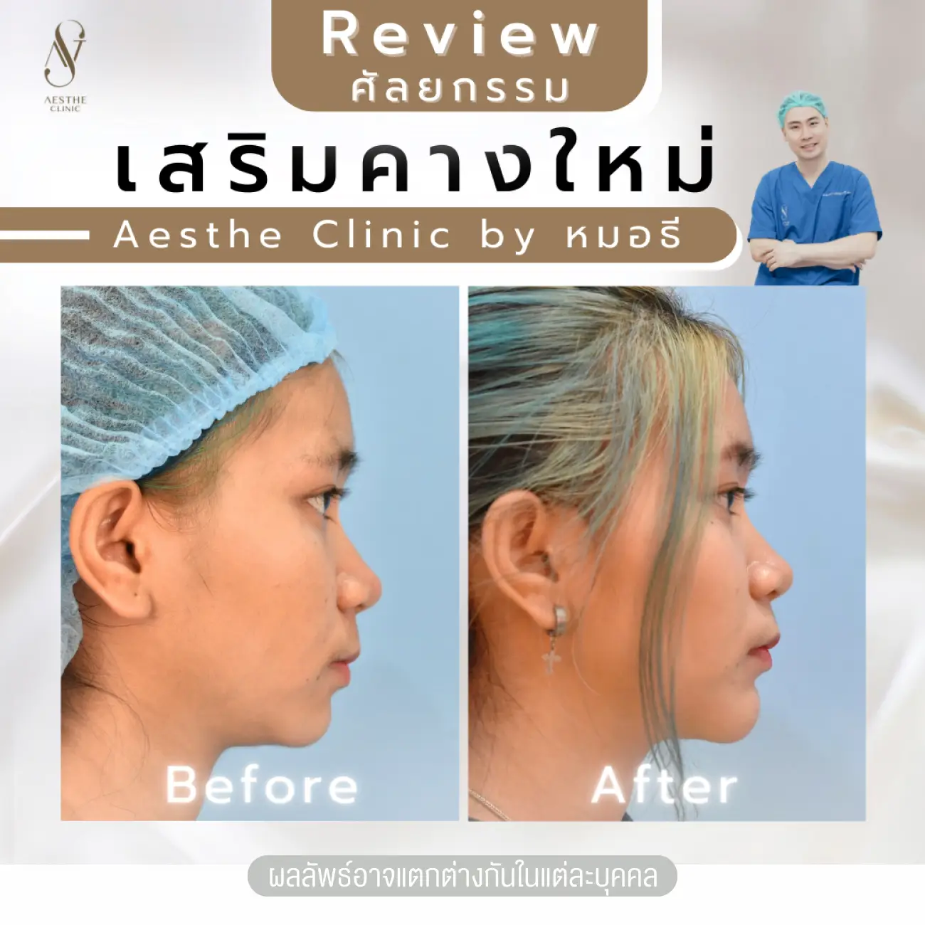 รีวิวทำคาง ที่ Aesthe Clinic (เอสเธ่คลินิก) รูปที่ 3