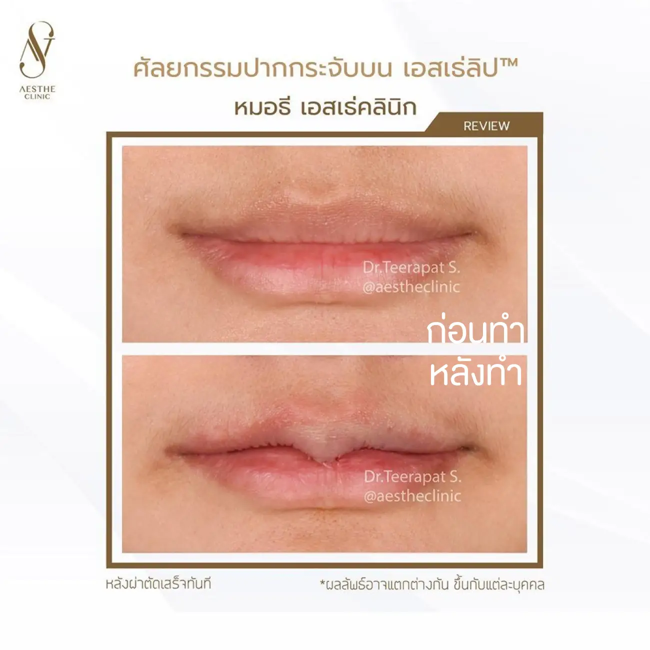 รีวิวศัลยกรรมปากกระจับ ที่ Aesthe Clinic (เอสเธ่คลินิก) รูปที่ 5