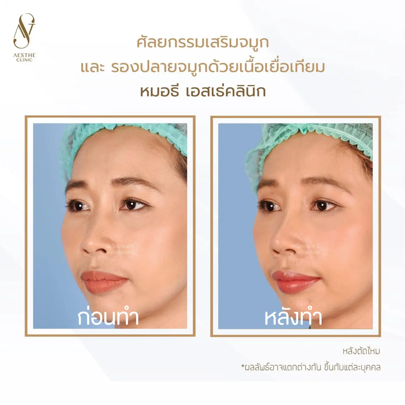 รีวิวแก้จมูกและรองปลายด้วยเนื้อเยื่อเทียม ที่ Aesthe Clinic (เอสเธ่คลินิก) รูปที่ 5