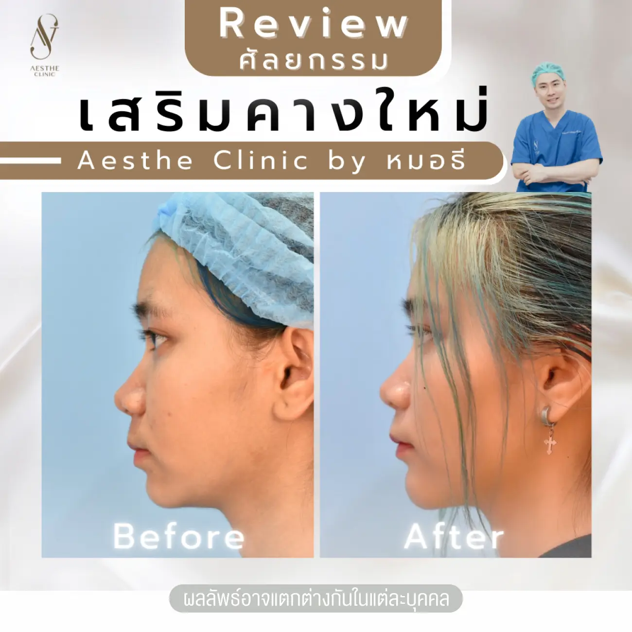 รีวิวทำคาง ที่ Aesthe Clinic (เอสเธ่คลินิก) รูปที่ 4