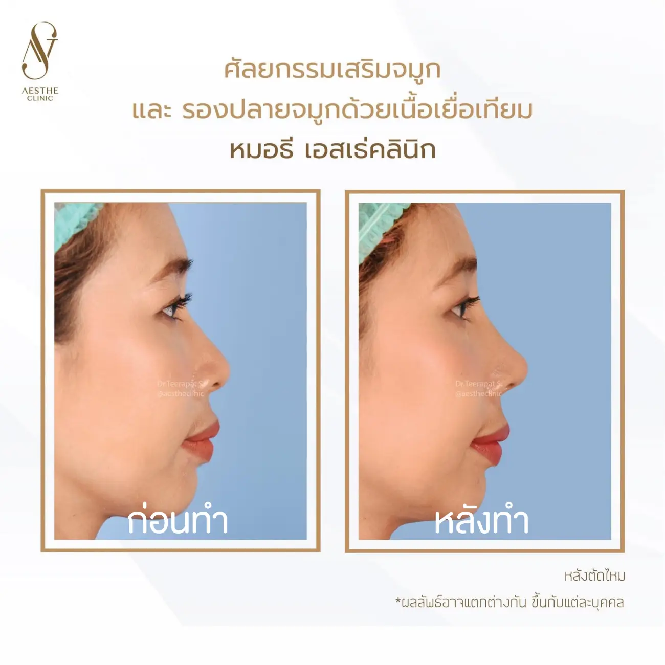 รีวิวแก้จมูกและรองปลายด้วยเนื้อเยื่อเทียม ที่ Aesthe Clinic (เอสเธ่คลินิก) รูปที่ 6