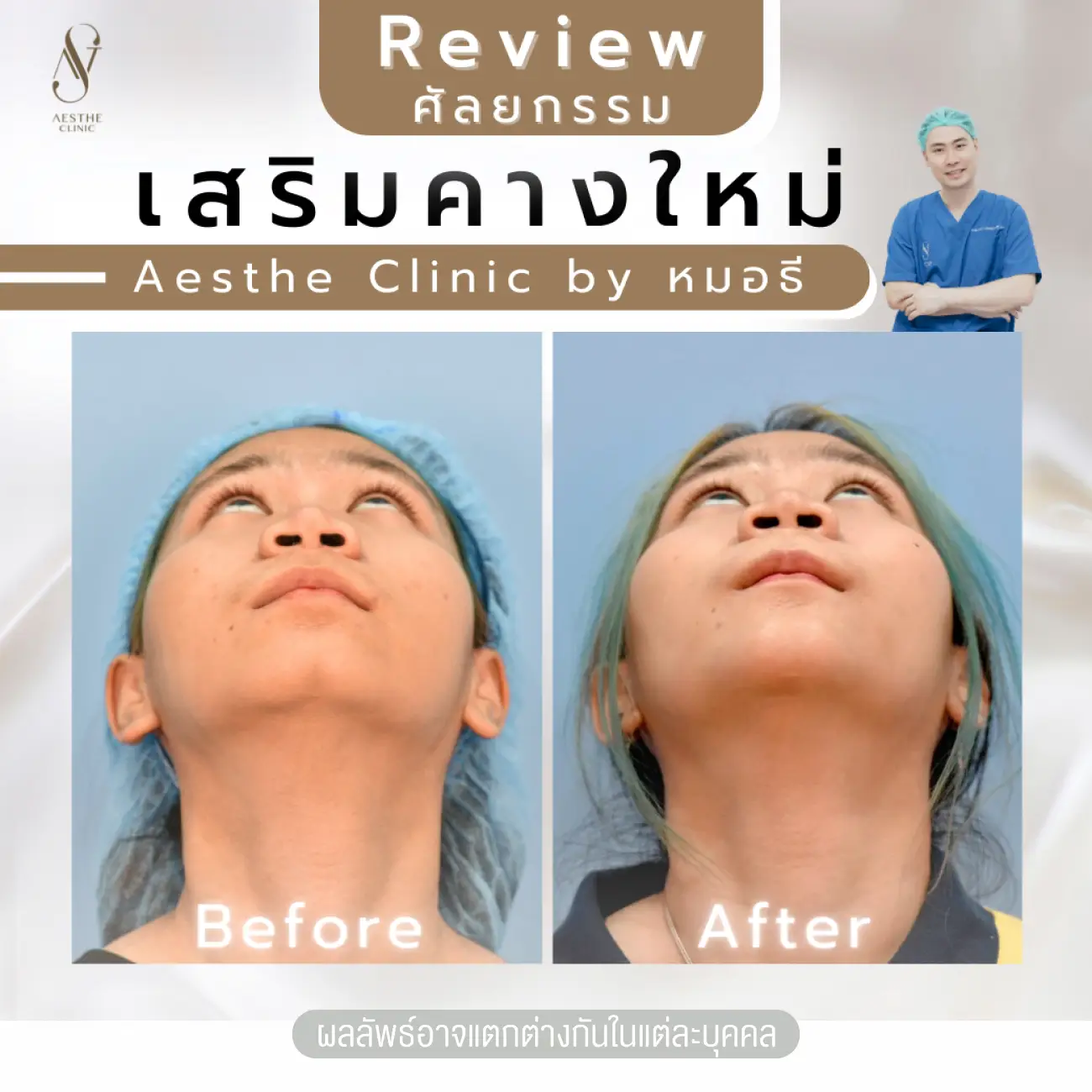 รีวิวทำคาง ที่ Aesthe Clinic (เอสเธ่คลินิก) รูปที่ 5