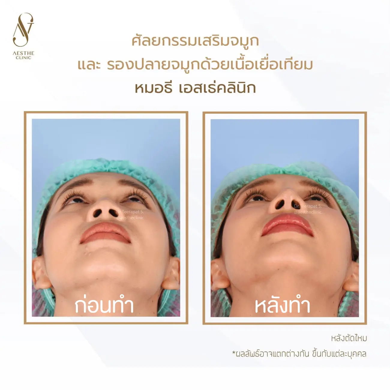 รีวิวแก้จมูกและรองปลายด้วยเนื้อเยื่อเทียม ที่ Aesthe Clinic (เอสเธ่คลินิก) รูปที่ 7