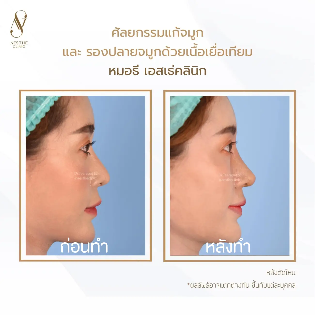 รีวิวแก้จมูกและรองปลายด้วยเนื้อเยื่อเทียม ที่ Aesthe Clinic (เอสเธ่คลินิก) รูปที่ 8