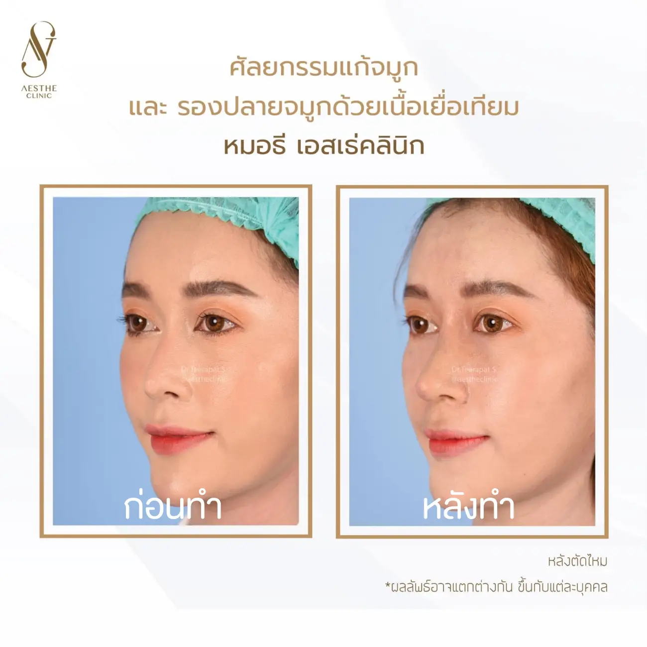 รีวิวแก้จมูกและรองปลายด้วยเนื้อเยื่อเทียม ที่ Aesthe Clinic (เอสเธ่คลินิก) รูปที่ 9