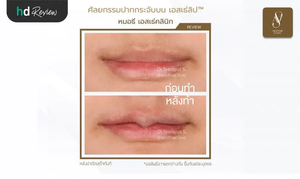 รีวิวศัลยกรรมปากกระจับ ที่ Aesthe Clinic (เอสเธ่คลินิก)