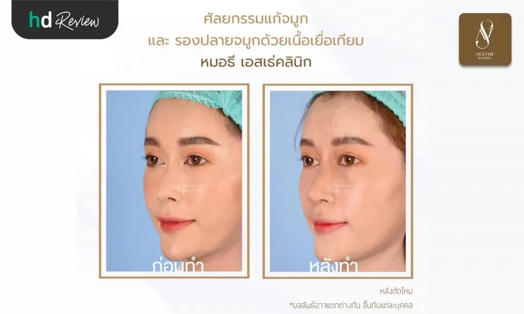 รีวิวแก้จมูกและรองปลายด้วยเนื้อเยื่อเทียม ที่ Aesthe Clinic (เอสเธ่คลินิก)