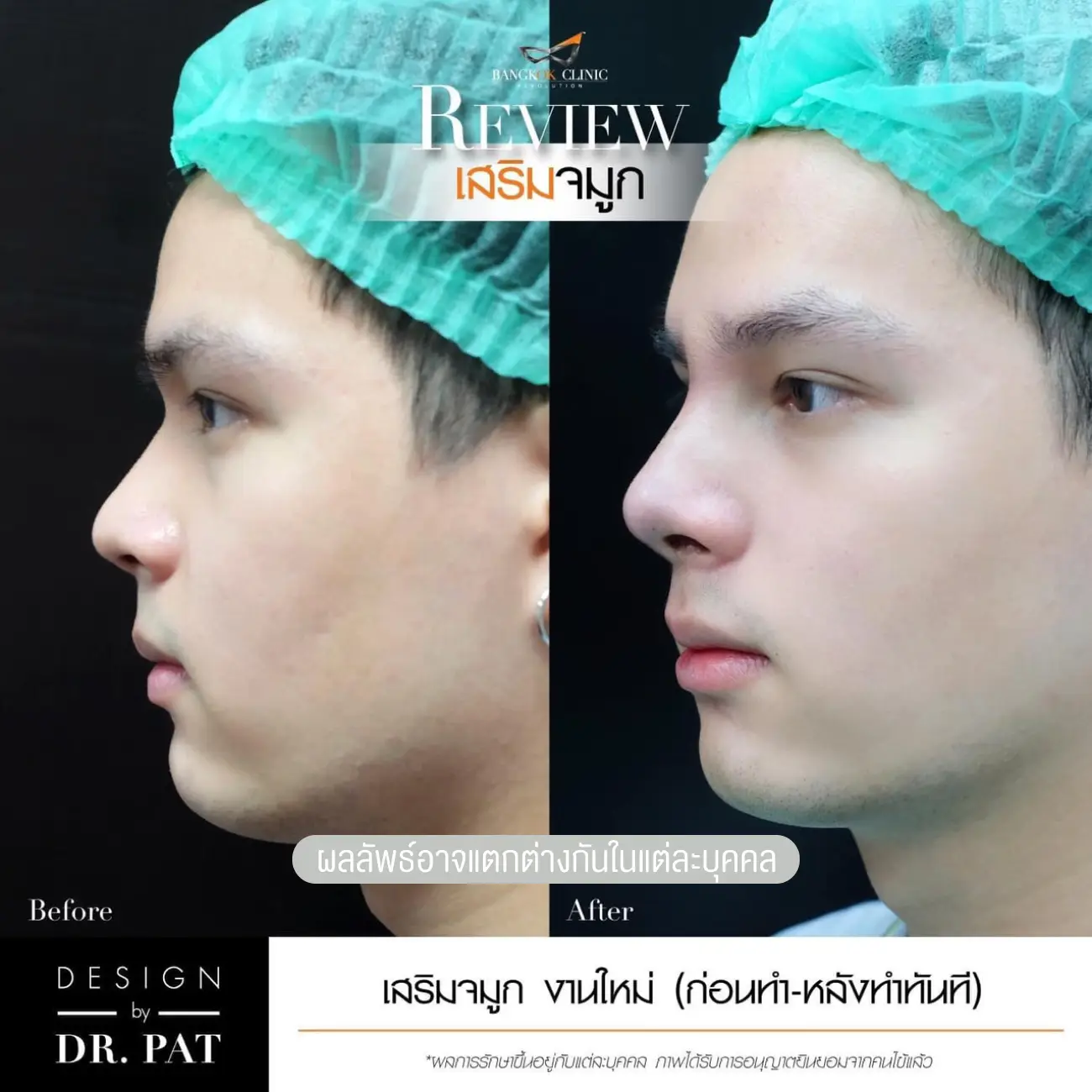 รีวิวทำจมูก เสริมจมูกผู้ชาย ที่ Bangkok Clinic & Design by Dr. Pat รูป 1